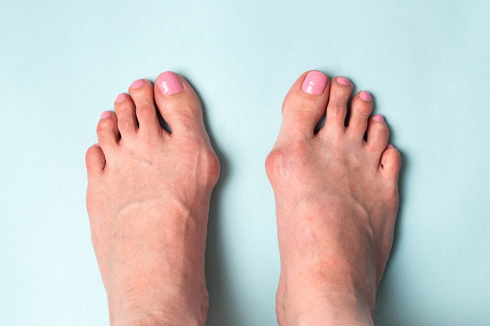 Hallux Valgus & Varus