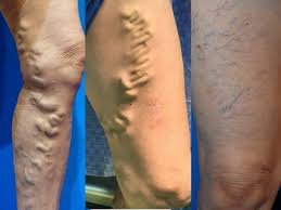 Varicose Veins